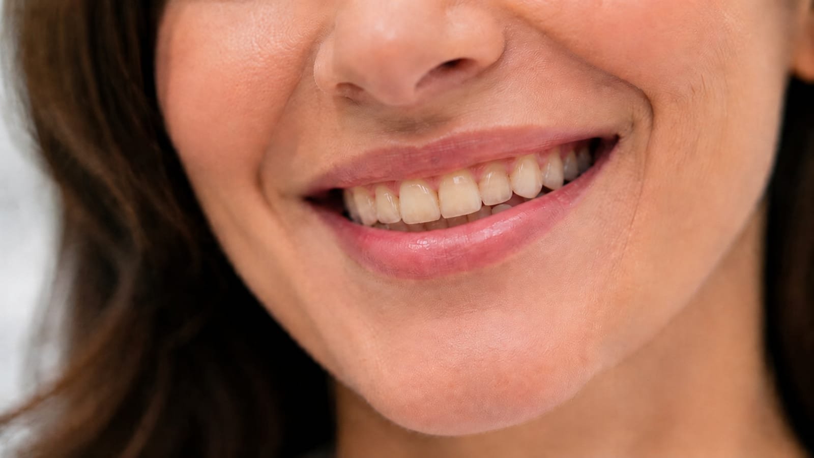 Antes — sorriso antes do tratamento